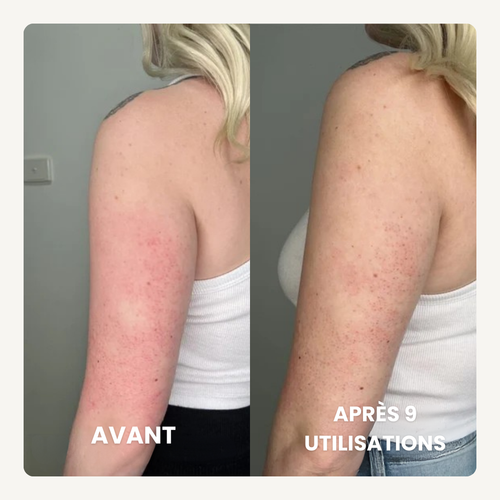 Concentré Lissant Triple-Acide® | Anti peau granuleuse