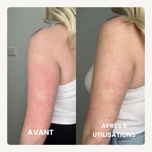 Concentré Lissant Triple-Acide® | Anti peau granuleuse
