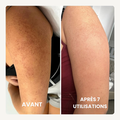 Concentré Lissant Triple-Acide® | Anti peau granuleuse