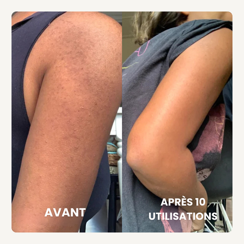 Concentré Lissant Triple-Acide® | Anti peau granuleuse